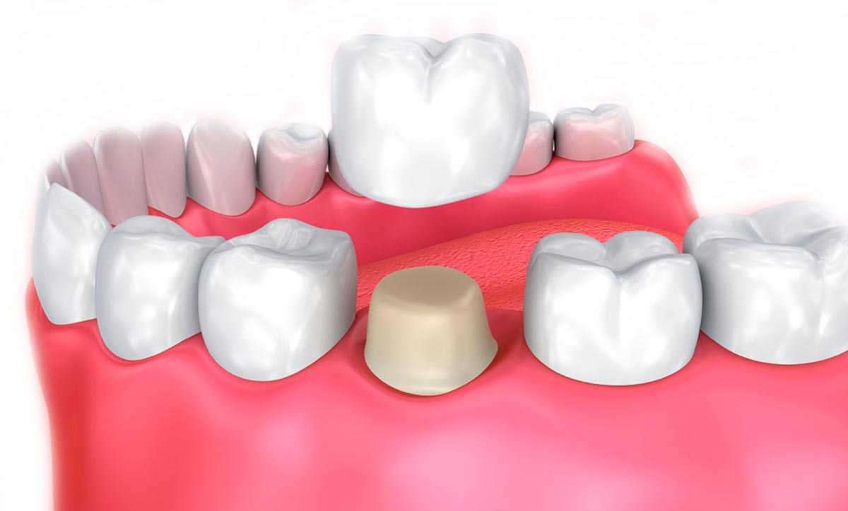 Коронка на зуб: цена в Москве на восстановление зуба и установку зубного  протеза в клинике стоматологии